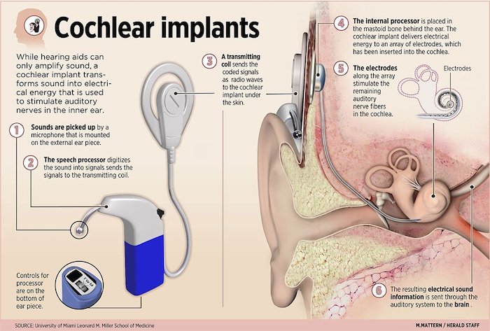 COCHLEAR IMPLANT Info